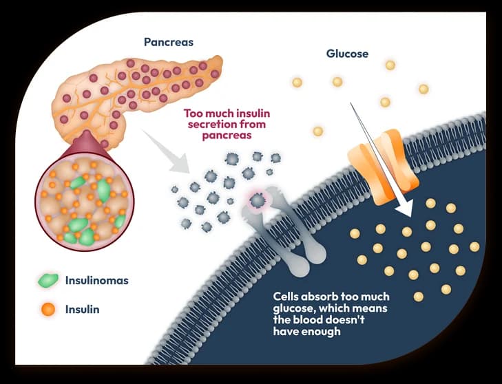 Illustration showing how insulinomas cause excess insulin release from the pancreas, leading to increased glucose uptake into cells.