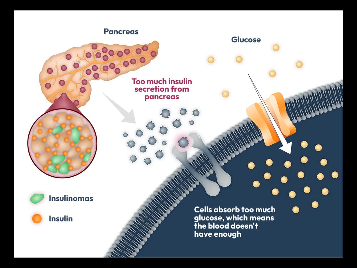 Illustration showing how insulinomas cause excess insulin release from the pancreas, leading to increased glucose uptake into cells.