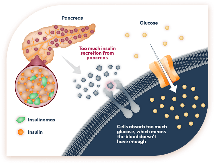 Illustration showing how insulinomas cause excess insulin release from the pancreas, leading to increased glucose uptake into cells.