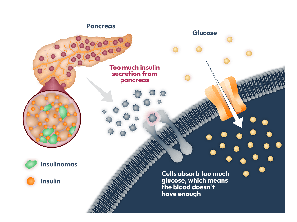 Illustration showing how insulinomas cause excess insulin release from the pancreas, leading to increased glucose uptake into cells.
